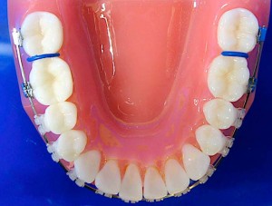 Orthodontic-Teeth-Separators