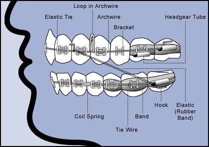 diagram-braces